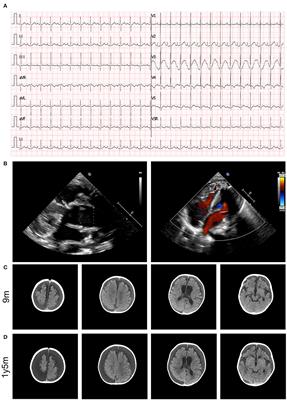 A novel homozygous variant of TMEM260 induced cardiac malformation and neurodevelopmental abnormality: case report and literature review